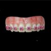 Pink Braces Upper Black HSFX